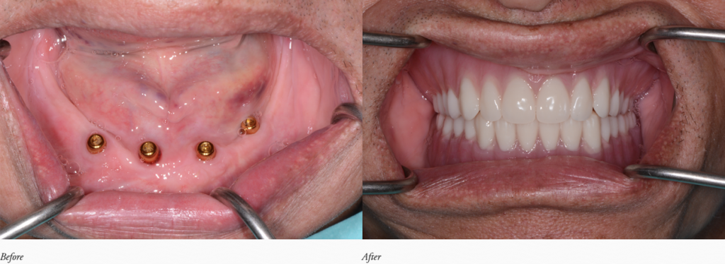 Dentures Case 2