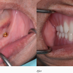 Dentures Case 2