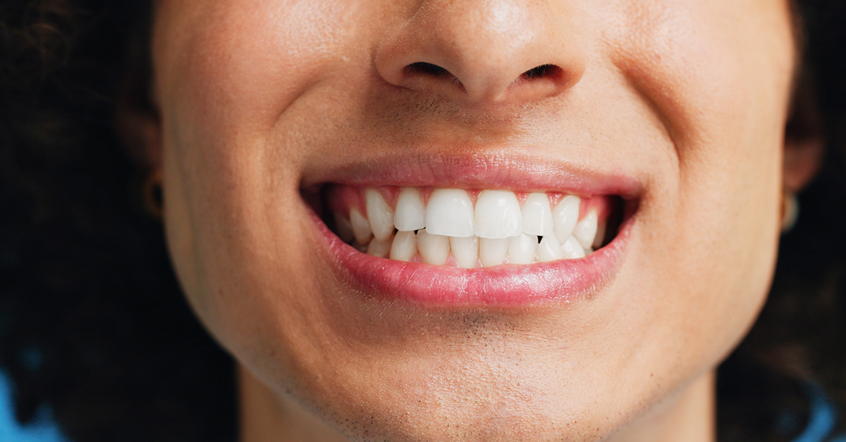 Is Professional Teeth Whitening Worth It? vs. Over-the-Counter Options
